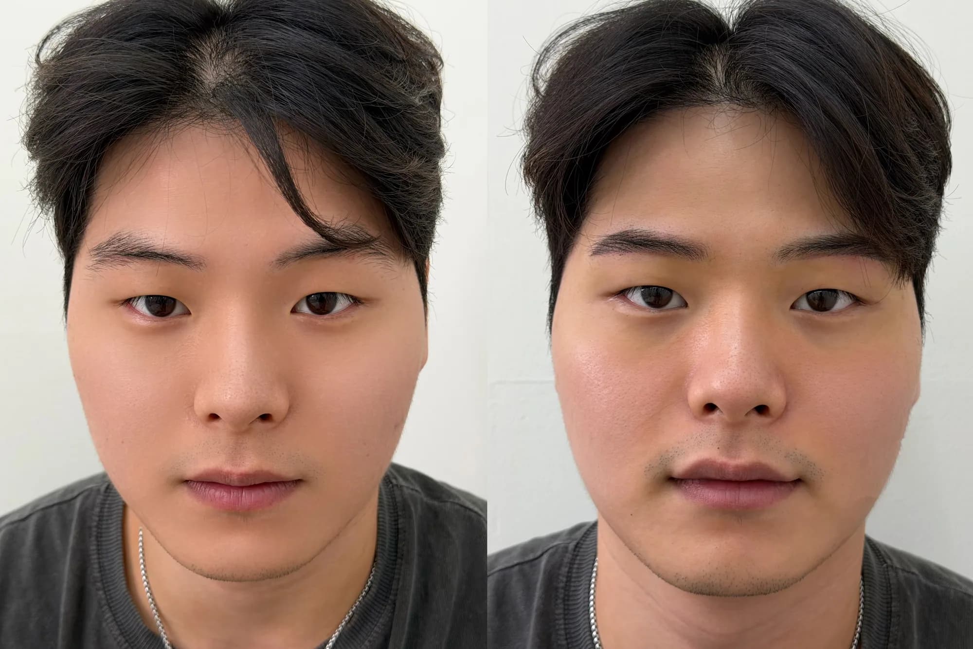 눈썹 시술 후 결과